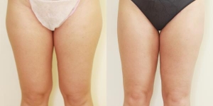 Liposuction Consultations in Drogheda