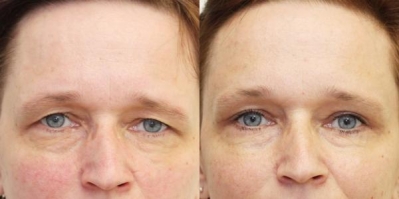 Eyelid Surgery Consultations in Drogheda