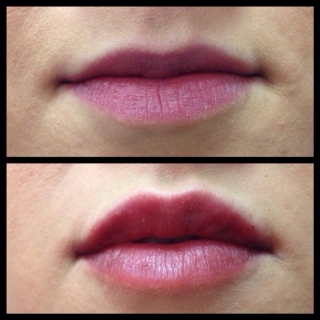 Botox & Fillers in Moda Donna Beauty Clinics!