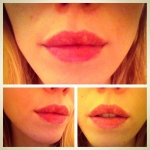 Botox & Fillers in Moda Donna Beauty Clinics!