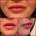 Botox & Fillers in Moda Donna Beauty Clinics!