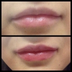 Botox & Fillers in Moda Donna Beauty Clinics!