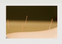 Acupuncture Clinic in Galway -  Acupuncture and Herb Clinic