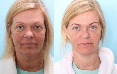 Facial Surgery Consultations in Swords