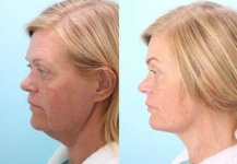 Facial Surgery Consultations in Swords