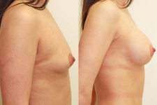 Breast lift consultations in Dublin. Surgeries for the best price