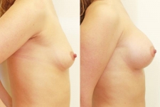 Breast lift consultations in Dublin. Surgeries for the best price