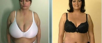 Breast lift consultations in Dublin. Surgeries for the best price