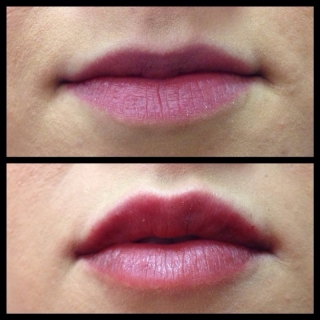 Botox/Fillers in Dublin