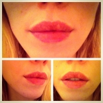 Botox/Fillers in Dublin