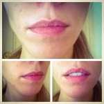 Botox/Fillers in Dublin