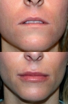 Botox/Fillers in Dublin