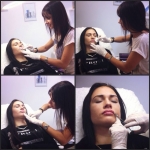 Botox/Fillers in Dublin