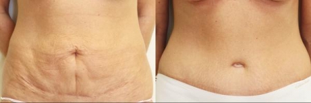 Body Contouring Consultations in Dublin. Best price surgeries in Lithuania