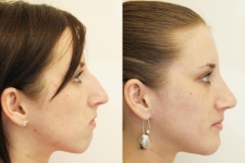 Body Contouring Consultations in Dublin. Best price surgeries in Lithuania
