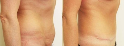 Body Contouring Consultations in Dublin. Best price surgeries in Lithuania