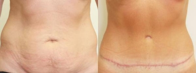 Body Contouring Consultations in Dublin. Best price surgeries in Lithuania