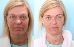 Body Contouring Consultations in Dublin. Best price surgeries in Lithuania