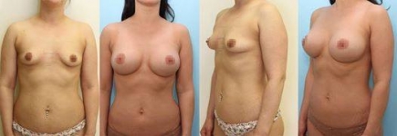 Body Contouring Consultations in Dublin. Best price surgeries in Lithuania