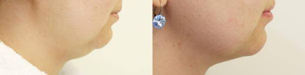 Body Contouring Consultations in Dublin. Best price surgeries in Lithuania