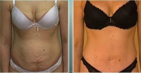 Body Contouring Consultations in Dublin. Best price surgeries in Lithuania