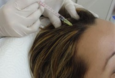 Biorevitalization. Hair/Face Mesotherapy