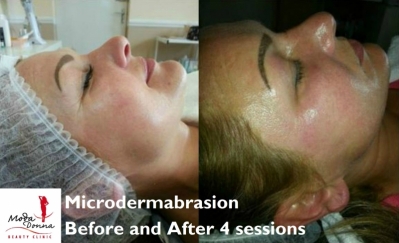 Microdermabrasion only €59