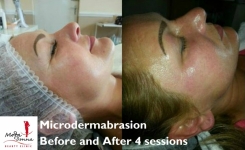 Micro-Needle Therapy only €79