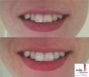 Laser Teeth Whitening only €69