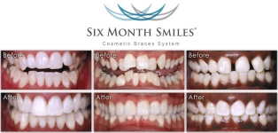 6 Month Smiles Clear Braces FREE CONSULTATION