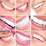 Pagrindinės dantų rovimo priežastys: