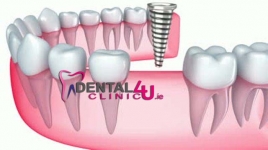 Имплантация зубов, импланты, стоматологическая хирургия Дублинe
