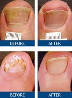 NAIL FUNGUS AND TREATMENT OPTIONS