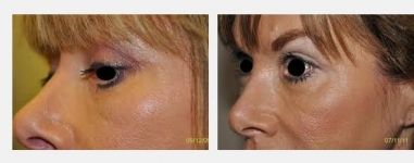 Rhinoplasty Surgeons in Dublin - The Clinic Sandymount Green