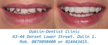 Ultra Thin Veneers – The latest breakthrough in dental veneers!