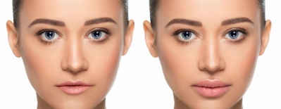 Botox Woolwich |  Health  Aesthetic Clinic